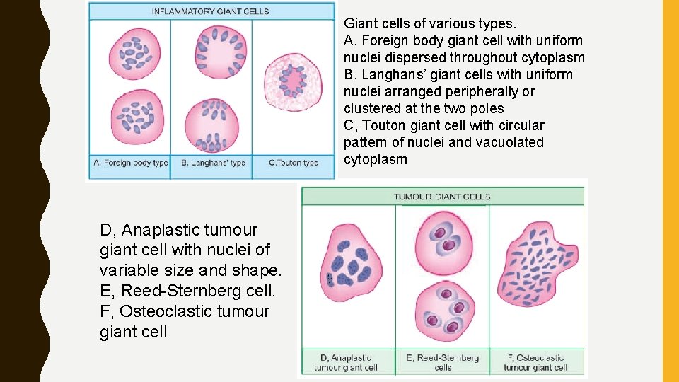 Giant cells of various types. A, Foreign body giant cell with uniform nuclei dispersed Giant cells of various types. A, Foreign body giant cell with uniform nuclei dispersed