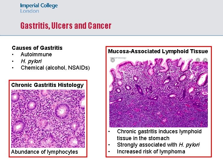 Gastritis, Ulcers and Cancer Causes of Gastritis • Autoimmune • H. pylori • Chemical