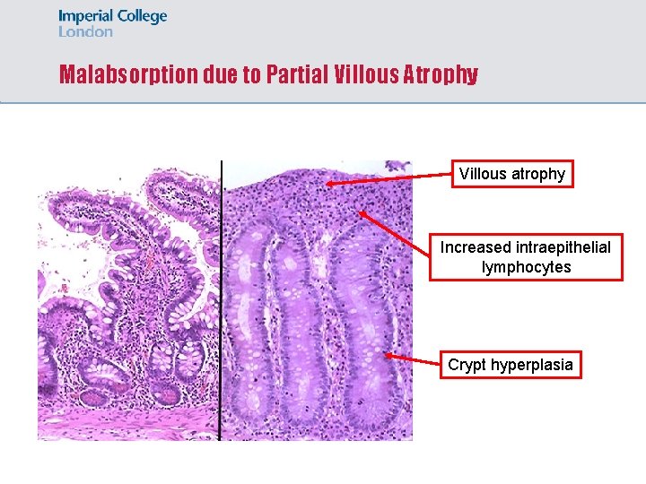 Malabsorption due to Partial Villous Atrophy Villous atrophy Increased intraepithelial lymphocytes Crypt hyperplasia 