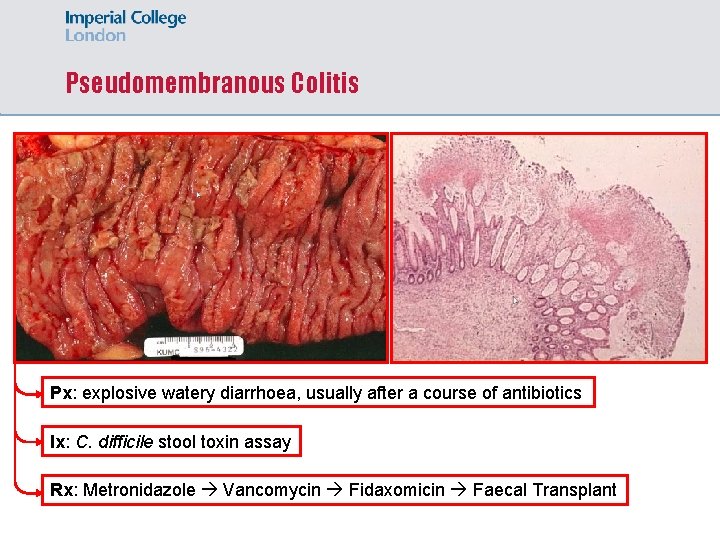 Pseudomembranous Colitis Px: explosive watery diarrhoea, usually after a course of antibiotics Ix: C.