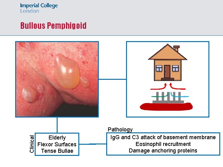 Clinical Bullous Pemphigoid Elderly Flexor Surfaces Tense Bullae Pathology Ig. G and C 3