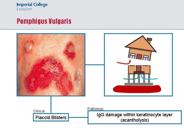 Pemphigus Vulgaris Clinical Flaccid Blisters Pathology Ig. G damage within keratinocyte layer (acantholysis) 