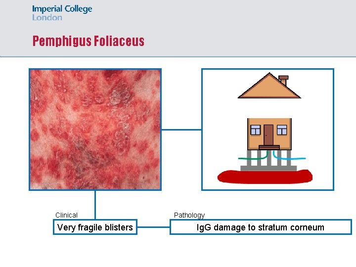 Pemphigus Foliaceus Clinical Very fragile blisters Pathology Ig. G damage to stratum corneum 