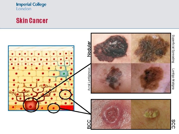 Nodular Superficial Spreading Acral Lentiginous Lentigo Maligna BCC Skin Cancer SCC 