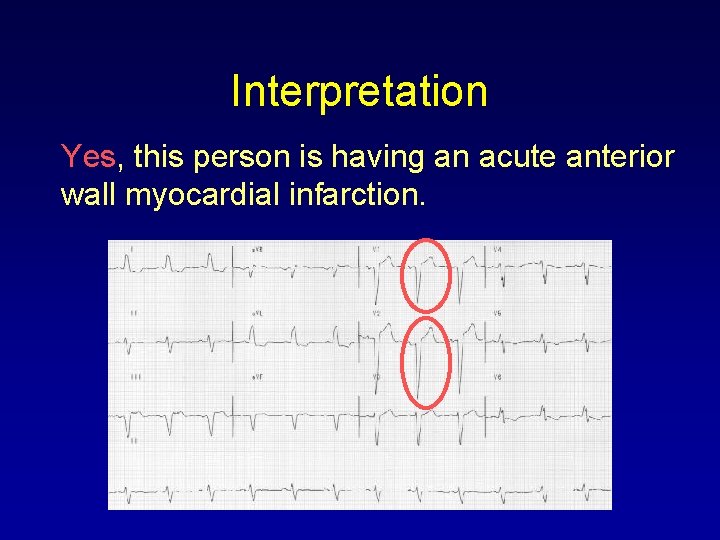 Interpretation Yes, this person is having an acute anterior wall myocardial infarction. 