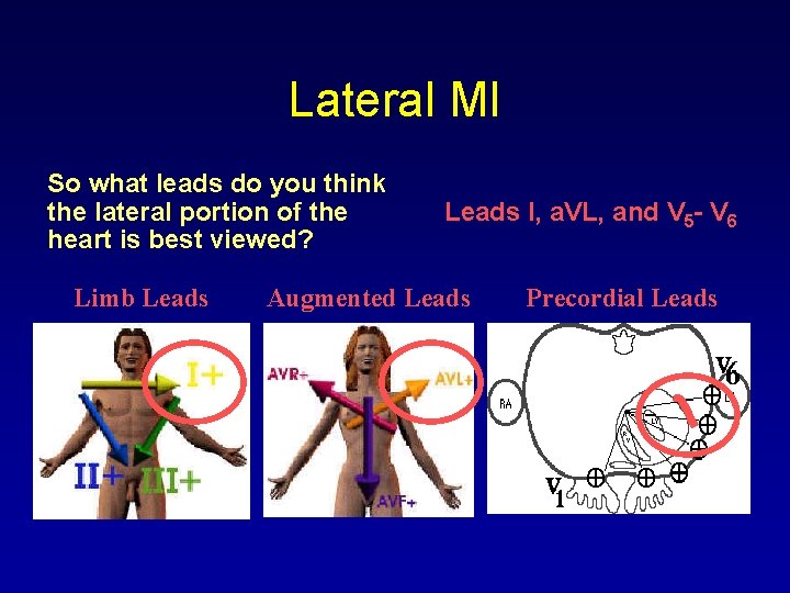 Lateral MI So what leads do you think the lateral portion of the heart