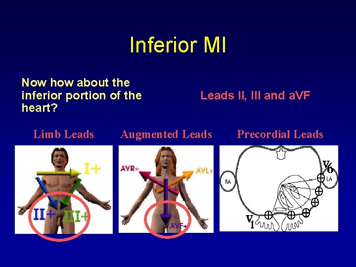 Inferior MI Now how about the inferior portion of the heart? Limb Leads II,