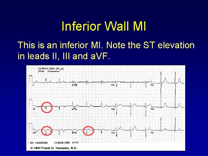 Inferior Wall MI This is an inferior MI. Note the ST elevation in leads