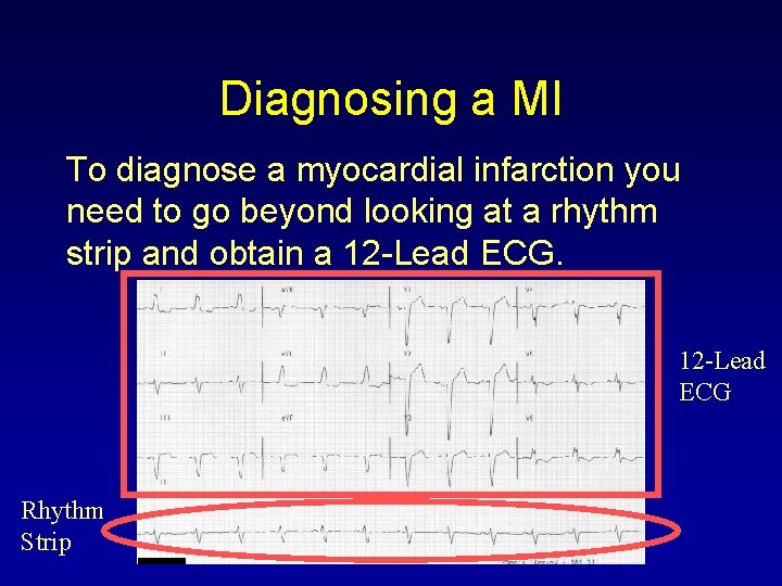 Diagnosing a MI To diagnose a myocardial infarction you need to go beyond looking
