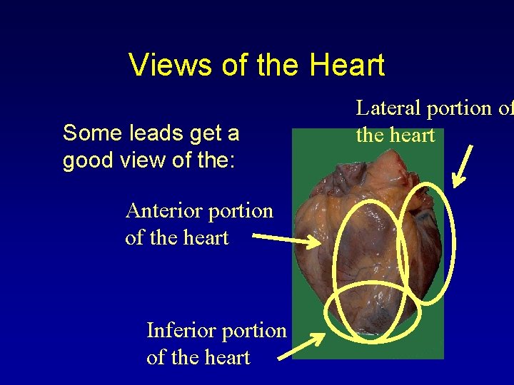 Views of the Heart Some leads get a good view of the: Anterior portion