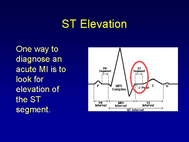 ST Elevation One way to diagnose an acute MI is to look for elevation