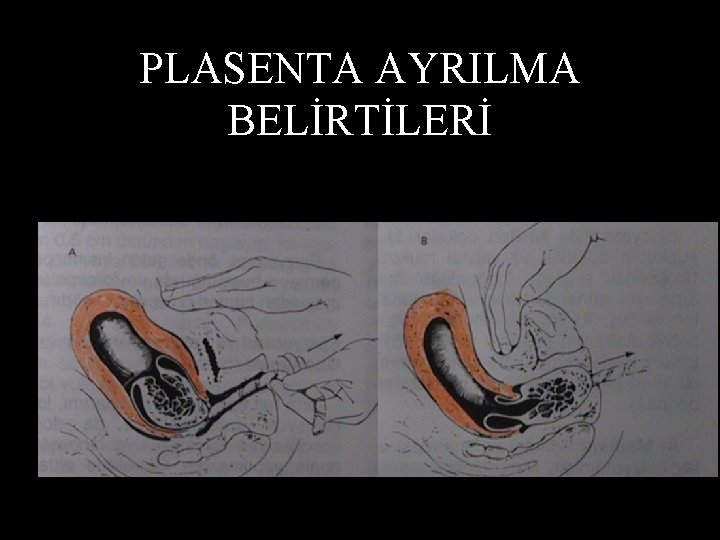 PLASENTA AYRILMA BELİRTİLERİ • • Vajenden kan boşalır. Uterus yukarı çekilir. Kord aşağı doğru