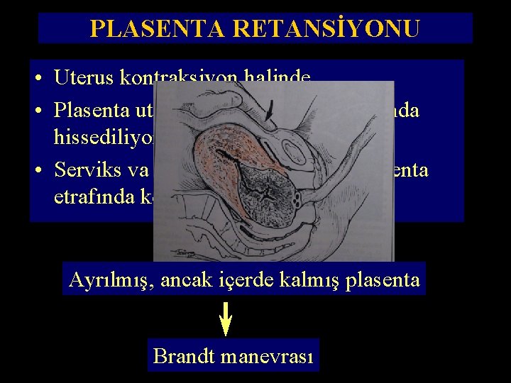 PLASENTA RETANSİYONU • Uterus kontraksiyon halinde, • Plasenta uterus boşluğunun alt kısmında hissediliyor, •