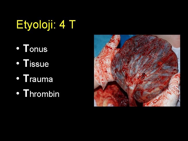 Etyoloji: 4 T • • Tonus Tissue Trauma Thrombin 
