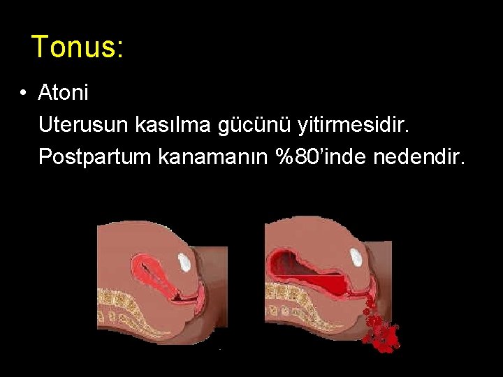 Tonus: • Atoni Uterusun kasılma gücünü yitirmesidir. Postpartum kanamanın %80’inde nedendir. 