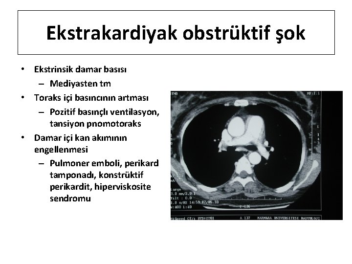 Ekstrakardiyak obstrüktif şok • Ekstrinsik damar basısı – Mediyasten tm • Toraks içi basıncının