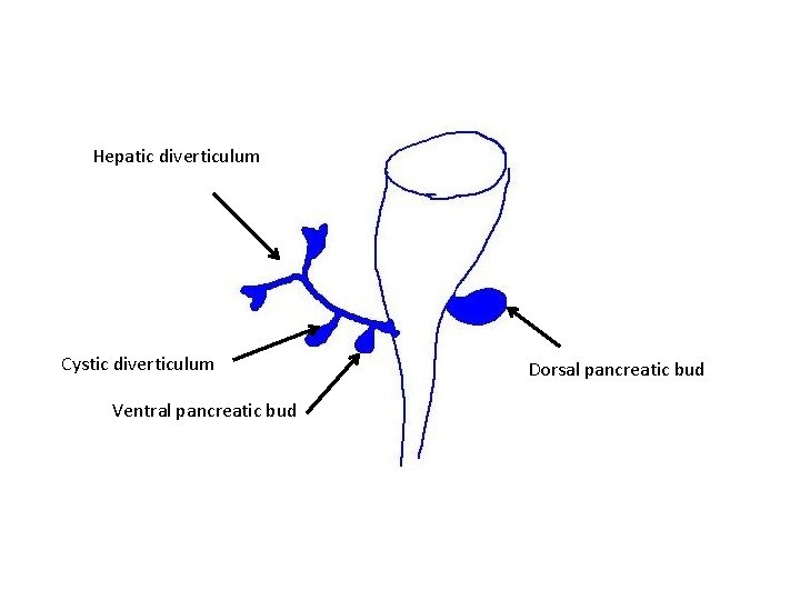 Hepatic diverticulum Cystic diverticulum Ventral pancreatic bud Dorsal pancreatic bud 