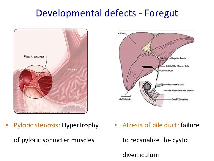 Developmental defects - Foregut • Pyloric stenosis: Hypertrophy • Atresia of bile duct: failure