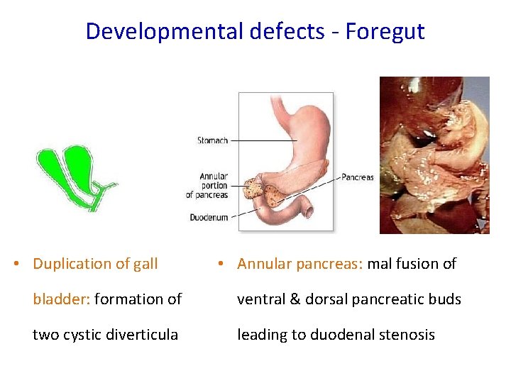 Developmental defects - Foregut • Duplication of gall • Annular pancreas: mal fusion of