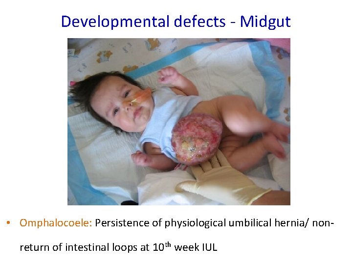 Developmental defects - Midgut • Omphalocoele: Persistence of physiological umbilical hernia/ nonreturn of intestinal