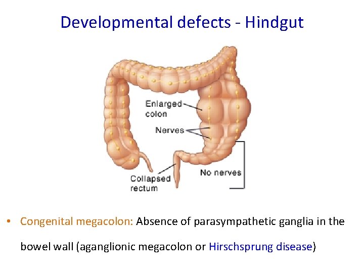 Developmental defects - Hindgut • Congenital megacolon: Absence of parasympathetic ganglia in the bowel