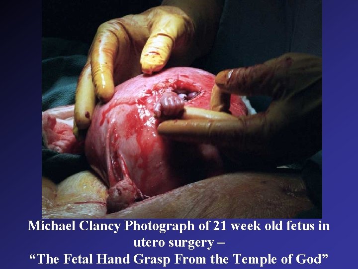 Michael Clancy Photograph of 21 week old fetus in utero surgery – “The Fetal