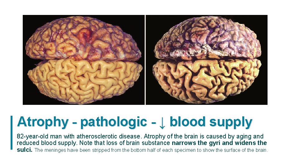 Atrophy - pathologic - ↓ blood supply 82 -year-old man with atherosclerotic disease. Atrophy