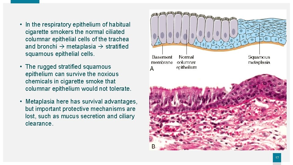  • In the respiratory epithelium of habitual cigarette smokers the normal ciliated columnar