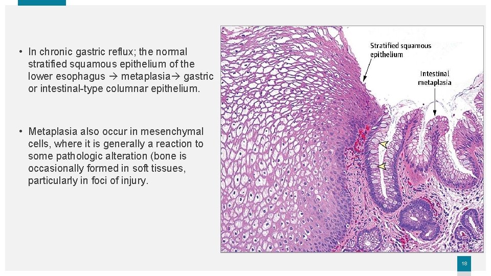  • In chronic gastric reflux; the normal stratified squamous epithelium of the lower