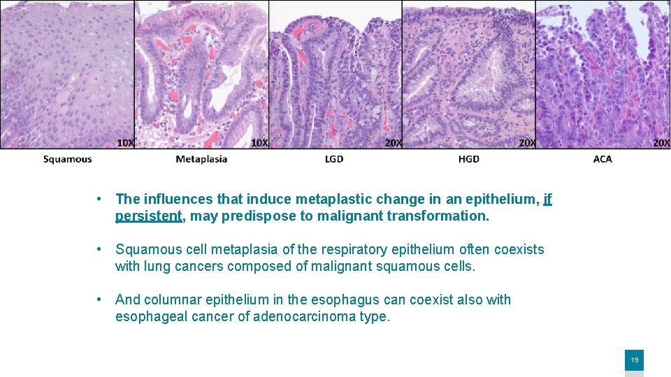  • The influences that induce metaplastic change in an epithelium, if persistent, may