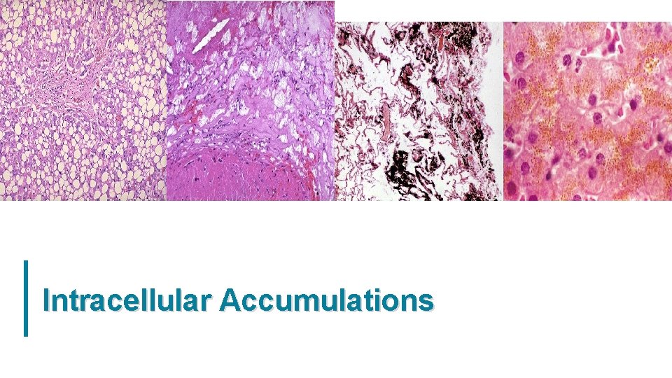 Intracellular Accumulations 20 