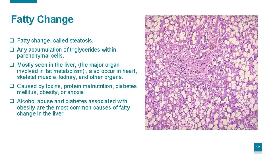 Fatty Change q Fatty change, called steatosis. q Any accumulation of triglycerides within parenchymal