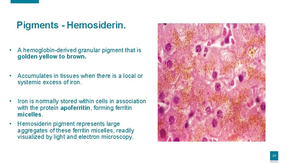 Pigments - Hemosiderin. • A hemoglobin-derived granular pigment that is golden yellow to brown.