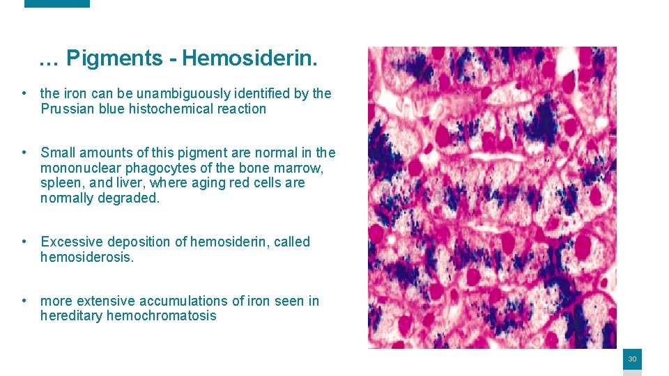 … Pigments - Hemosiderin. • the iron can be unambiguously identified by the Prussian