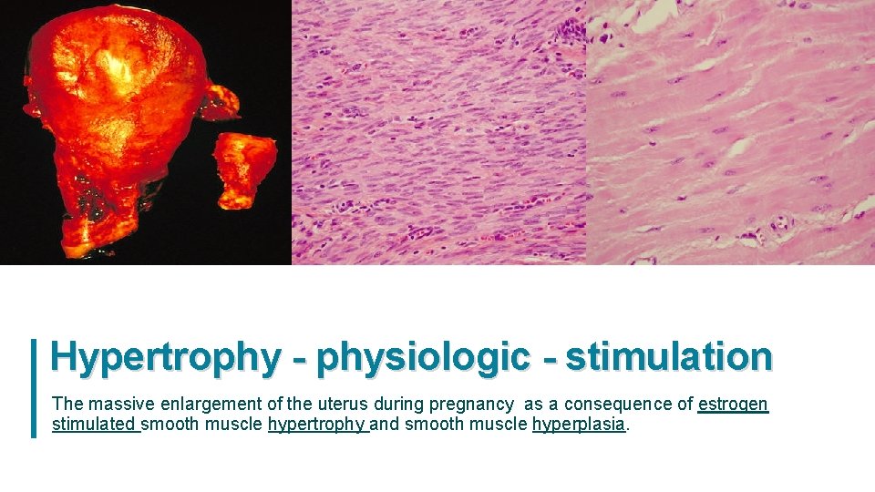 Hypertrophy - physiologic - stimulation The massive enlargement of the uterus during pregnancy as