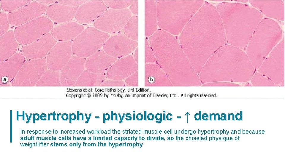 Hypertrophy - physiologic - ↑ demand In response to increased workload the striated muscle Hypertrophy - physiologic - ↑ demand In response to increased workload the striated muscle