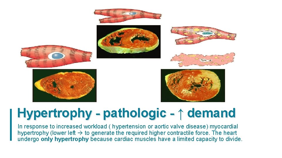 Hypertrophy - pathologic - ↑ demand In response to increased workload ( hypertension or