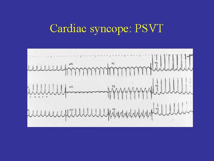 Cardiac syncope: PSVT 