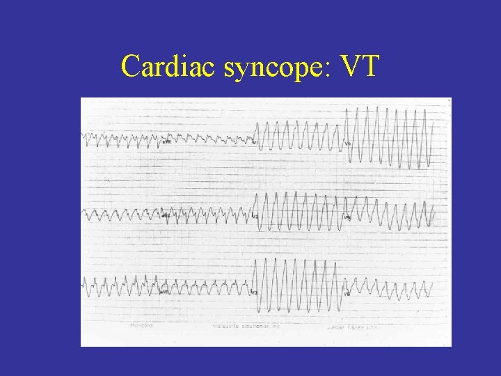 Cardiac syncope: VT 