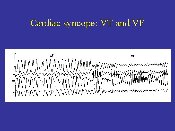 Cardiac syncope: VT and VF 