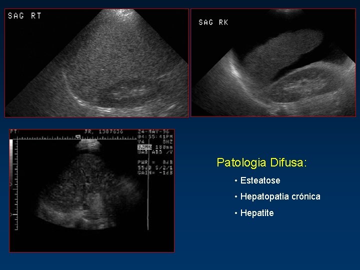 Patologia Difusa: • Esteatose • Hepatopatia crónica • Hepatite 