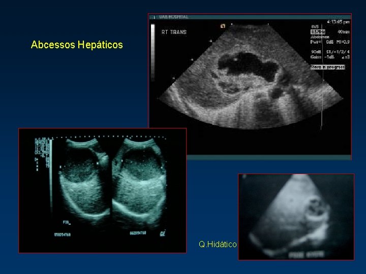 Abcessos Hepáticos Q. Hidático 