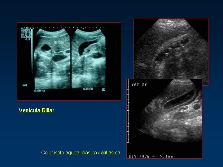 Vesícula Biliar Colecistite aguda litiásica / alitiásica 
