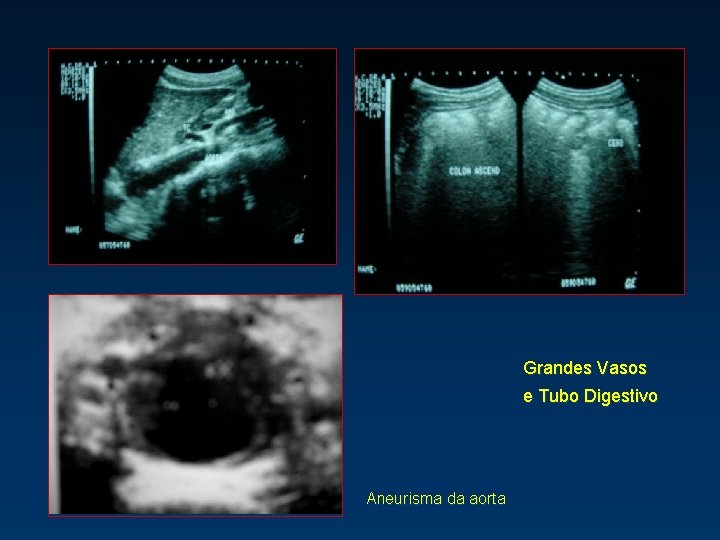 Grandes Vasos e Tubo Digestivo Aneurisma da aorta 