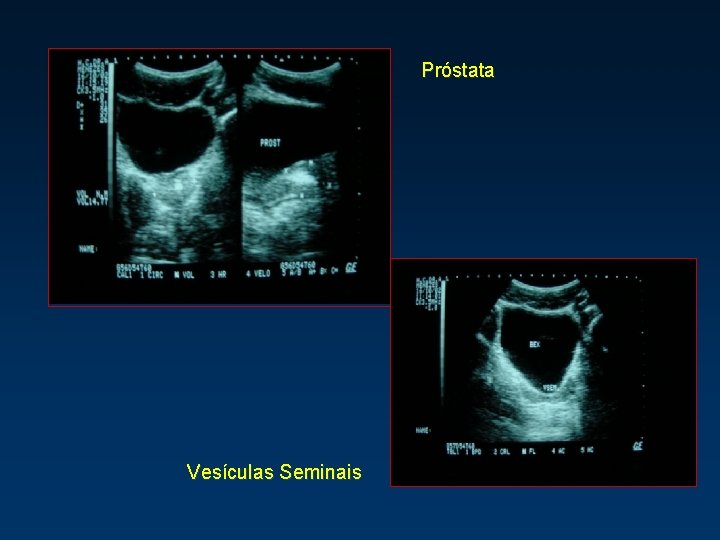 Próstata Vesículas Seminais 