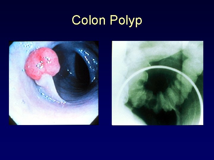 Colon Polyp 