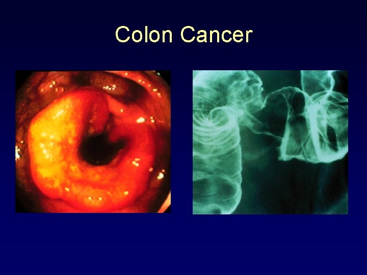 Colon Cancer 