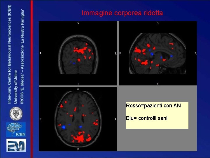 Immagine corporea ridotta Rosso=pazienti con AN Blu= controlli sani 