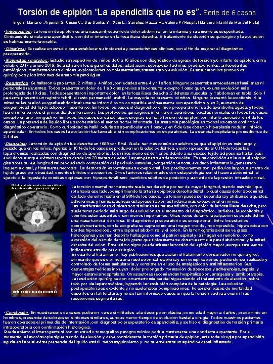 Torsión de epiplón. “La apendicitis que no es”. Serie de 6 casos Irigoin Mariano,