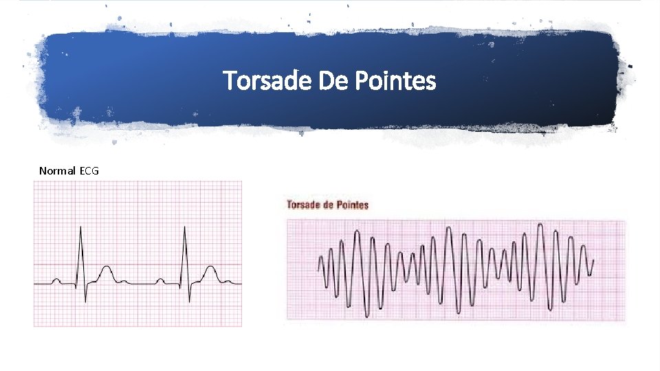 Torsade De Pointes Normal ECG 